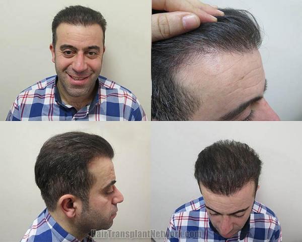 Hair transplant surgery before and after photos