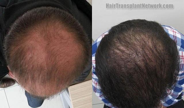 Hair restoration procedure before and after result photographs