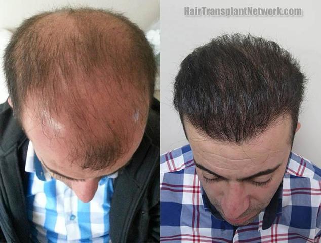 Hair transplantation surgery before and after images