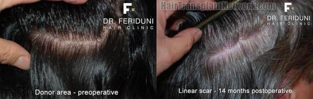 Hair restoration procedure before and after pictures