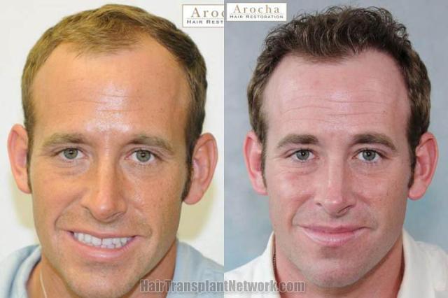 Hair restoration procedure before and after results