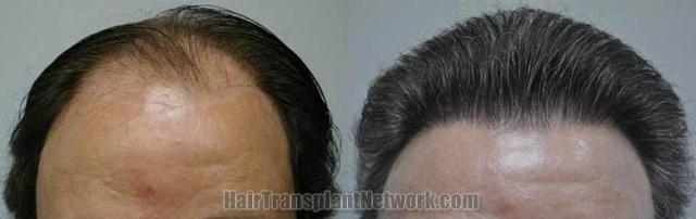 Hair restoration procedure before and after results