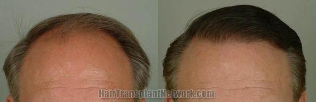 Hair restoration procedure before and after results