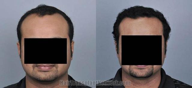 Hair transplantation surgery before and after photos