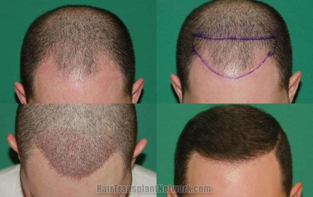 Hair restoration procedure before and after results