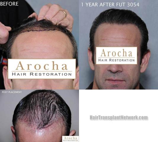 Hair restoration procedure before and after results