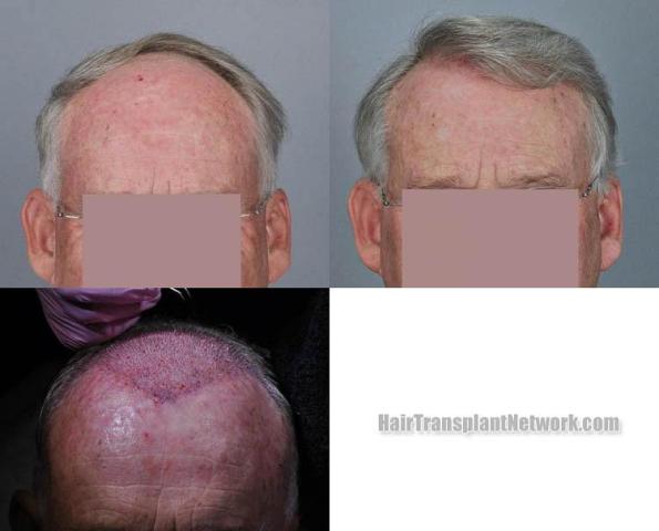 Hair restoration procedure before and after results