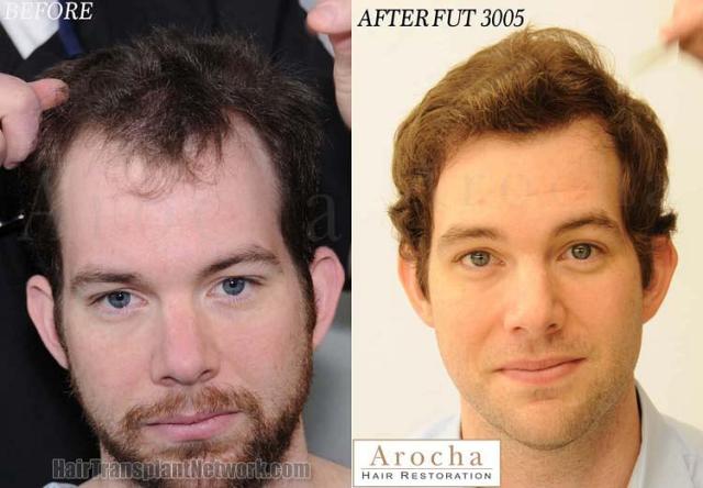 Hair restoration procedure before and after results