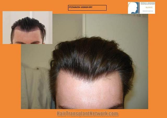 Front view - Before and after hair transplant surgery