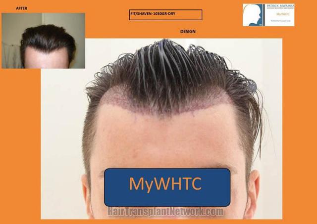 Before and after hair transplantation result photographs