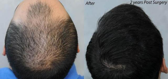 Hair transplantation surgery before and after photos