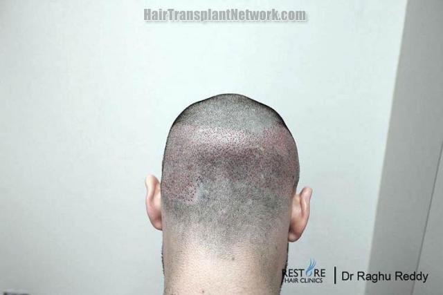 Hair restoration procedure before and after pictures