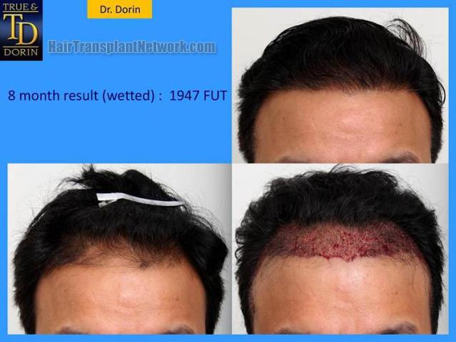 Hair restoration procedure before and after results