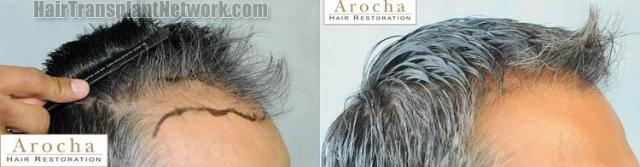 Hair transplantation surgery before and after photos