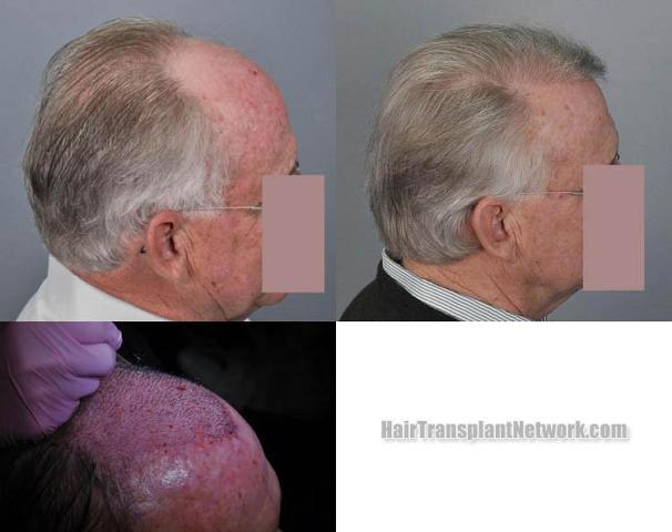 Hair transplantation surgery before and after images