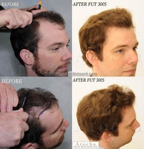 Hair transplantation surgery before and after images