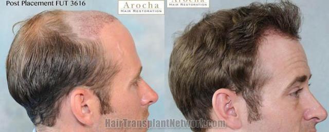 Hair transplantation surgery before and after images