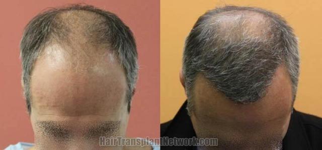 Hair transplantation surgery before and after photos