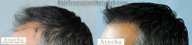 Hair transplantation surgery before and after images