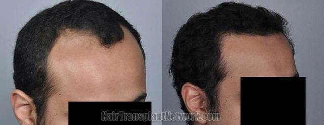 Hair transplantation surgery before and after pictures