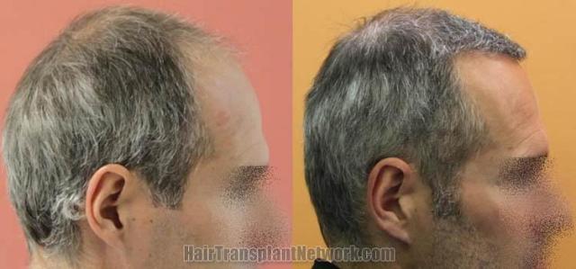 Hair transplantation surgery before and after images