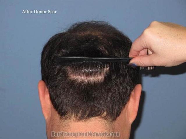 Hair transplantation surgery before and after pictures