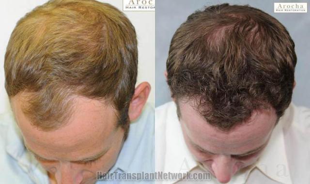 Hair transplantation surgery before and after photos