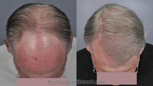 Hair transplantation surgery before and after photos