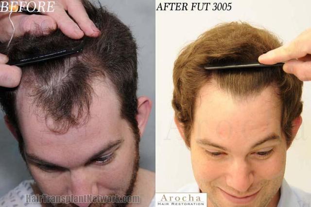 Hair transplantation surgery before and after photos