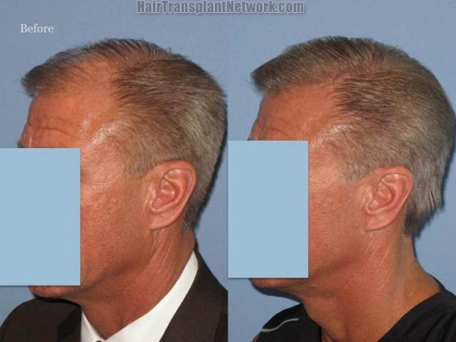 Hair transplantation surgery before and after pictures