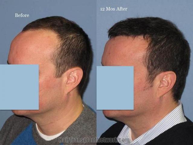 Hair transplantation surgery before and after images