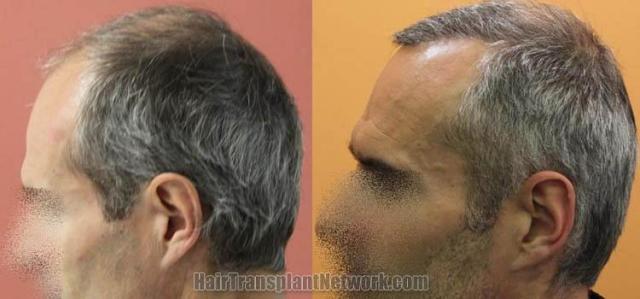 Hair transplantation surgery before and after pictures