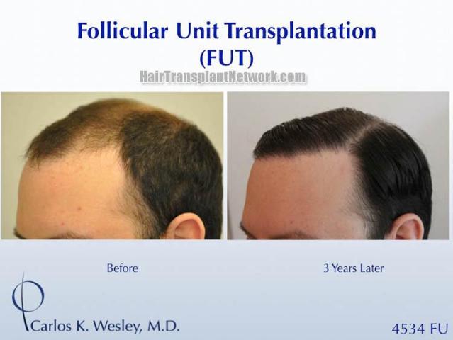 Surgical hair transplantation result photographs