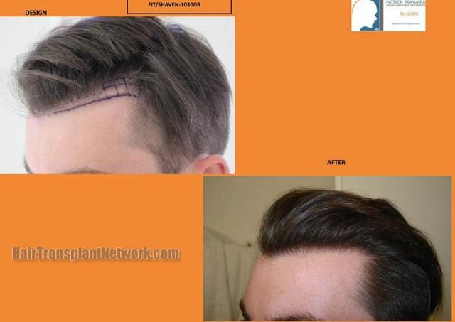 Hair restoration surgery before and after photos