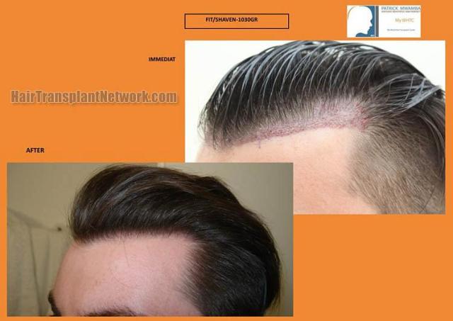 Hair restoration procedure before and after results