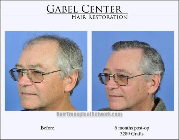 Hair transplant surgery before and after pictures