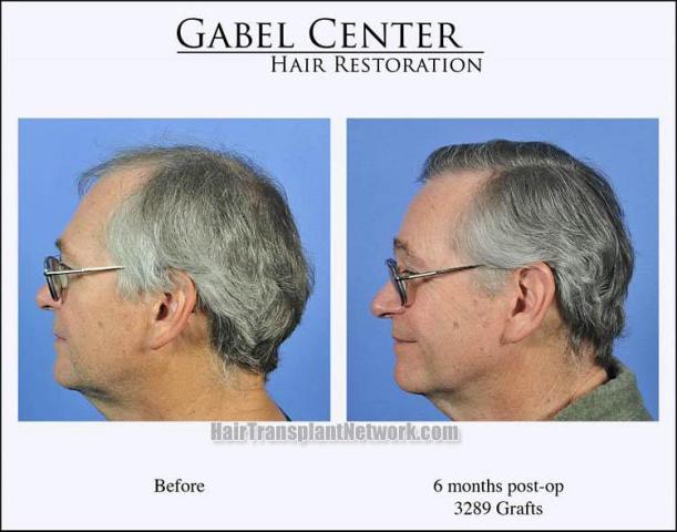 Hair transplantation surgery before and after photos