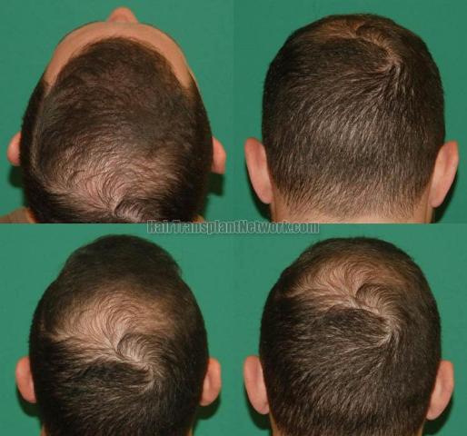 Hair transplantation surgery before and after photos