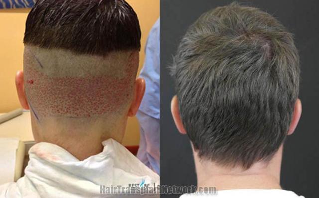 Hair transplantation surgery before and after pictures