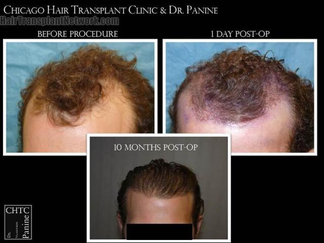 Before and after hair transplantation result photographs