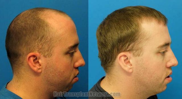 Hair transplantation surgery before and after photos