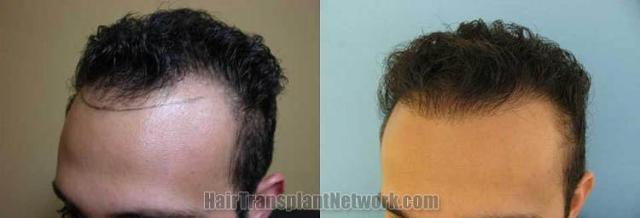 Hair transplantation surgery before and after photos