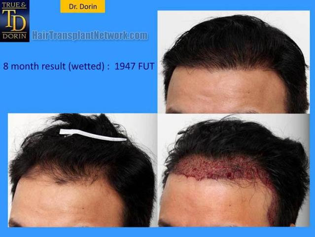 Hair transplantation surgery before and after pictures