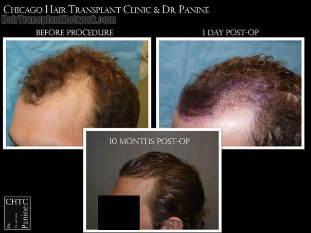 Hair transplantation surgery before and after images