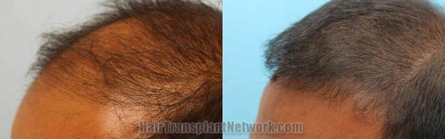 Hair transplantation surgery before and after images