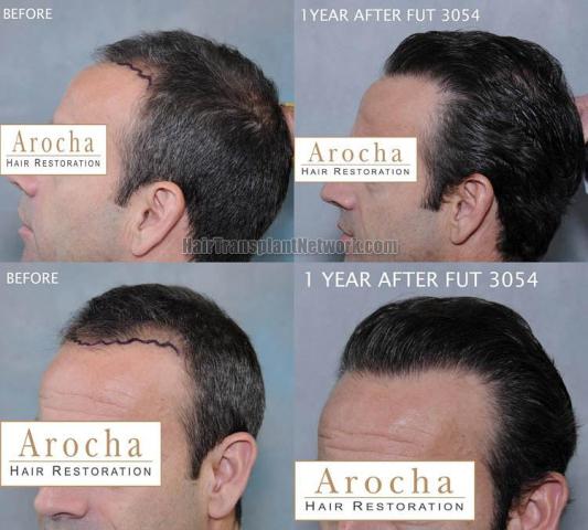 Hair transplantation surgery before and after pictures