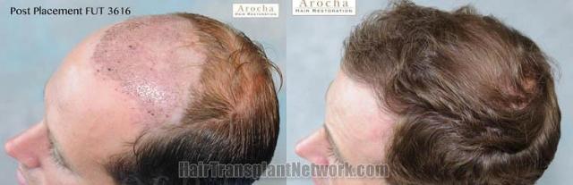 Hair transplantation surgery before and after pictures