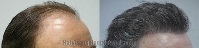 Hair transplantation surgery before and after images