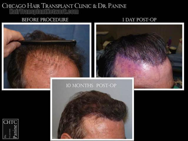 Hair transplantation surgery before and after images