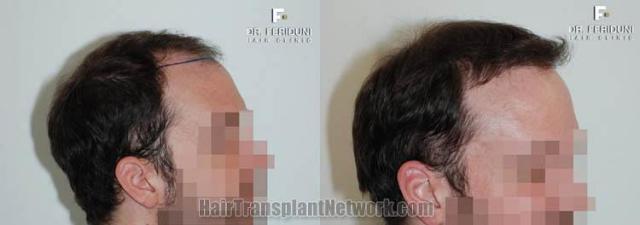 Hair transplantation surgery before and after images